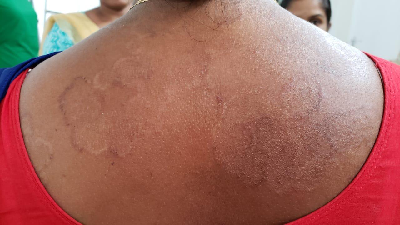 Epedemic skin disease attacks Mahendraganj area of Garo Hills | Assam Times