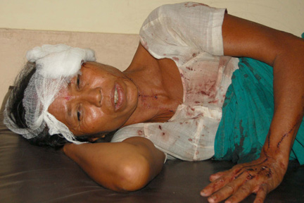 Powerful blast at Kumarikata: 5 dead, 50 injured