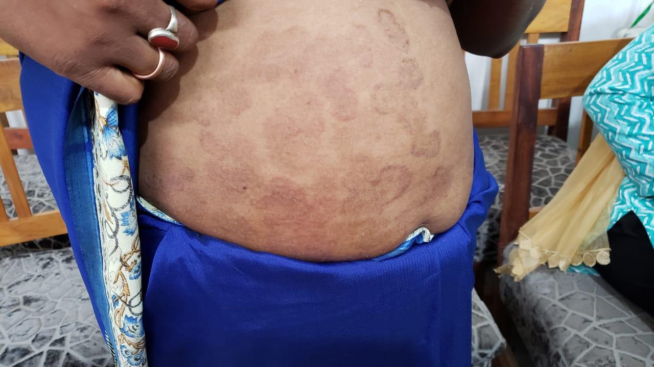 Epedemic skin disease attacks Mahendraganj area of Garo Hills