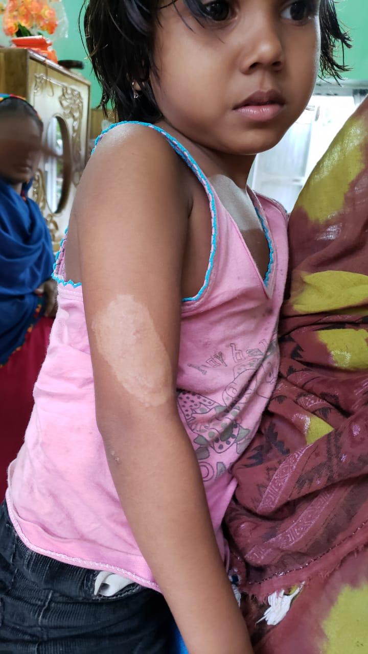 Epedemic skin disease attacks Mahendraganj area of Garo Hills