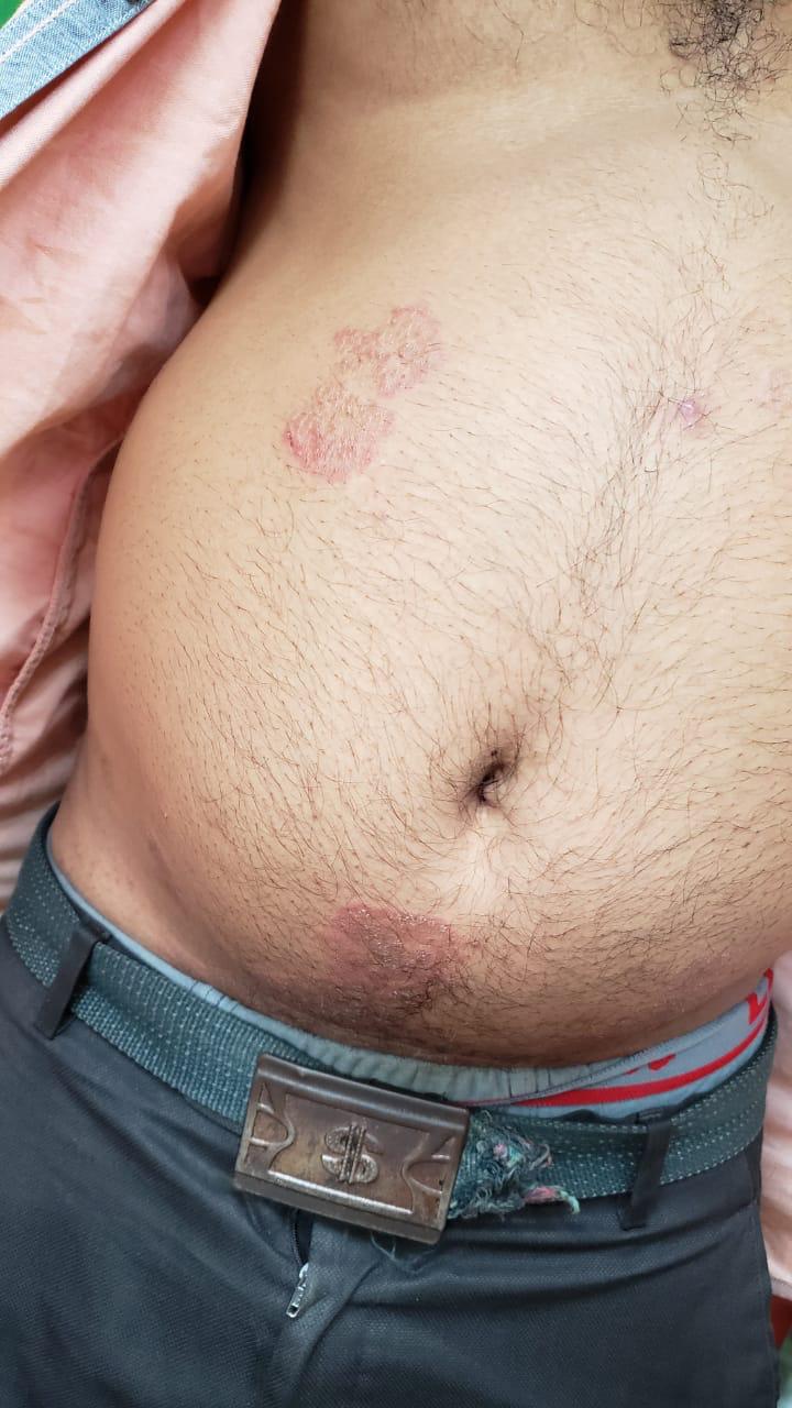 Epedemic skin disease attacks Mahendraganj area of Garo Hills