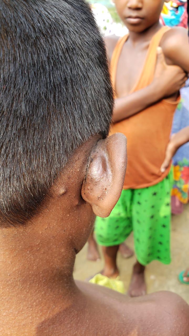 Epedemic skin disease attacks Mahendraganj area of Garo Hills