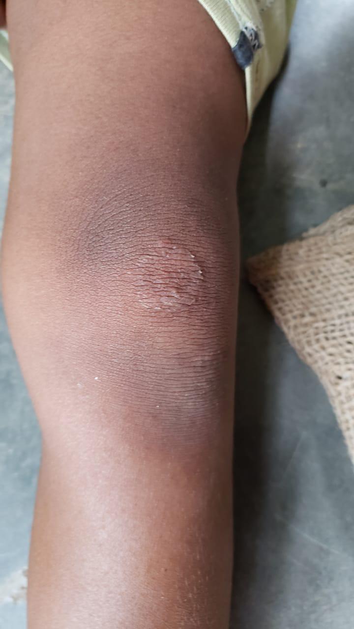 Epedemic skin disease attacks Mahendraganj area of Garo Hills
