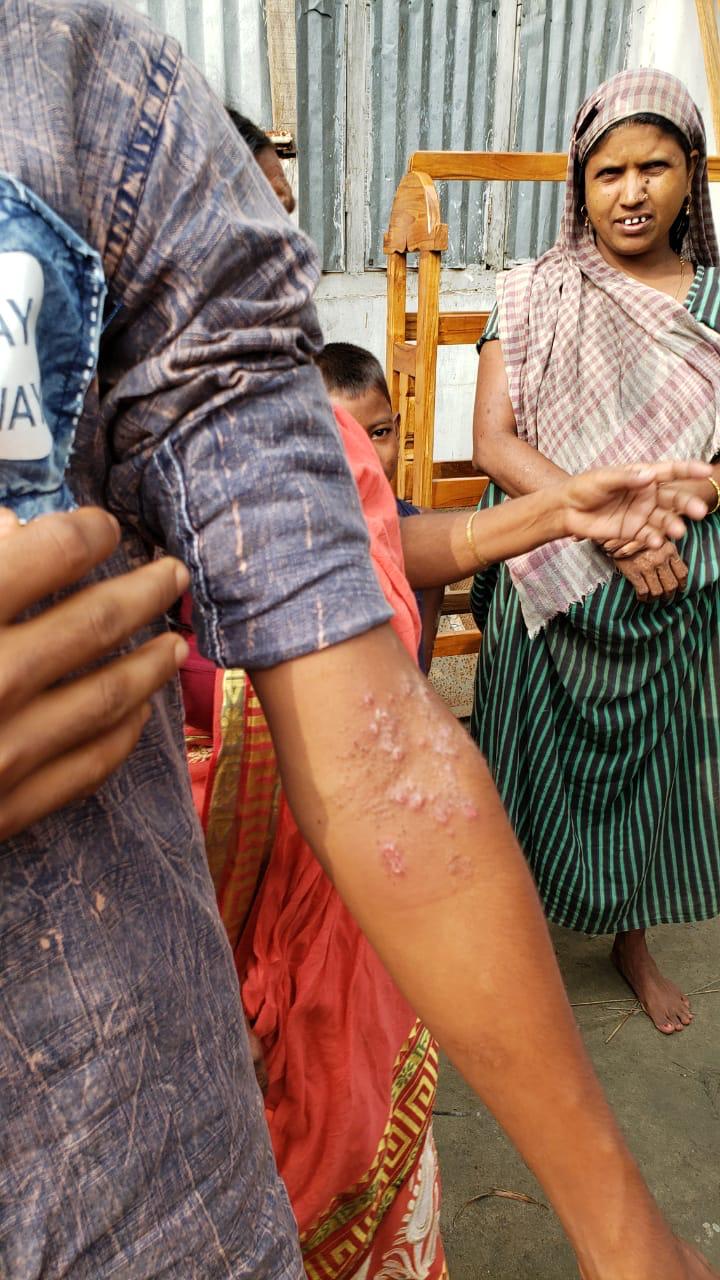 Epedemic skin disease attacks Mahendraganj area of Garo Hills