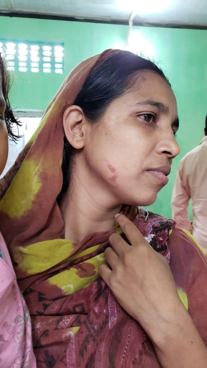 Epedemic skin disease attacks Mahendraganj area of Garo Hills
