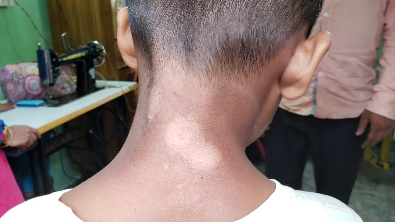 Epedemic skin disease attacks Mahendraganj area of Garo Hills